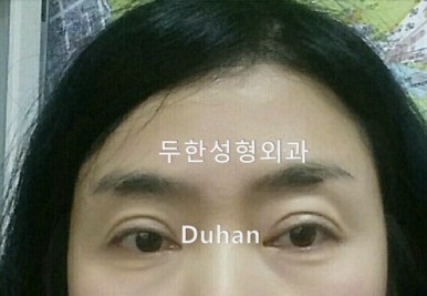 [두한성형외과 쌍커풀재수술] - [심한 소세지눈, 두줄따기, 쌍꺼풀 흉터] 관련 이미지 1