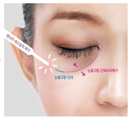 두한성형외과 눈밑수술 - 다크서클 수술 전후 관리 안내 관련 이미지 114