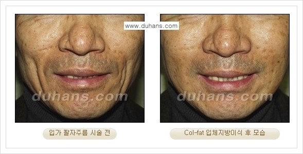 [두한성형외과 경쟁력 미세지방이식] - [지방이식 특허 Col-fat 미세지방이식 성공사례 안내] 관련 이미지 11