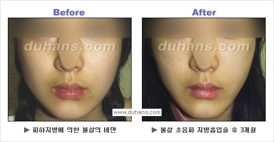[두한성형외과 경쟁력 얼굴지방흡입] - [통통한 볼살, 두툼한 턱살(턱선)의 지방흡입] 관련 이미지 17