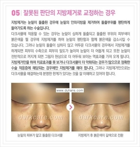 [두한성형외과 경쟁력 눈밑성형] - [눈밑 지방재배치 문제점] 관련 이미지 5