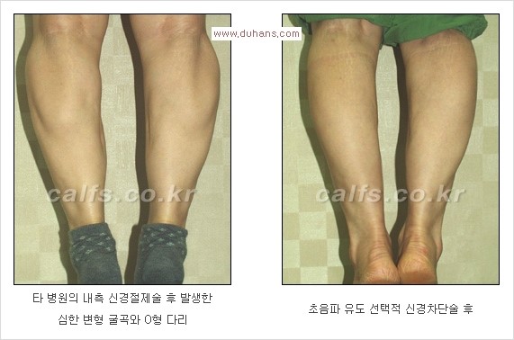 [두한성형외과 Dr. 컬럼] - [종아리 근육퇴축술로 가장 선호하는 비절개 초음파 유도 선택적 신경차단술] 관련 이미지 2