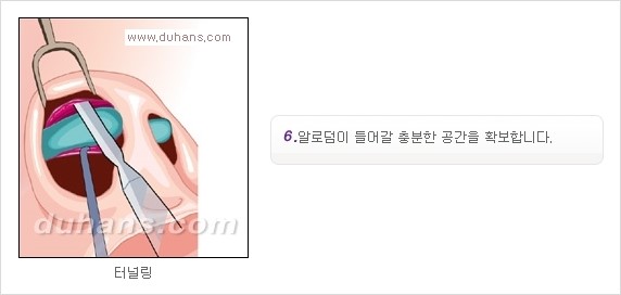 [두한성형외과 경쟁력 코성형] - [코성형을 위한 알로덤(슈어덤) 수술, 실리콘 수술 안내] 관련 이미지 9