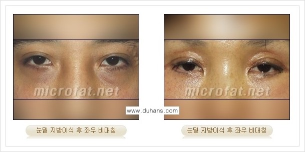 ​[두한성형외과 경쟁력 미세지방이식] - [타병원에서의 미세지방이식 부작용 종류와 문제점 안내] 관련 이미지 6