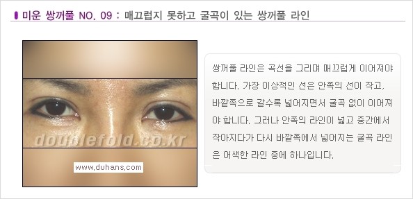 [두한성형외과 경쟁력 쌍꺼풀 재수술, 극한 재수술] - [일반적인 기준의 미운 쌍꺼풀과 아름다운 쌍꺼풀 안내] 관련 이미지 9