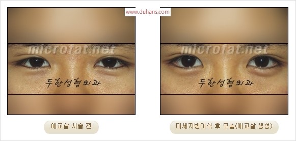 ​﻿[두한성형외과 경쟁력 지방이식] - [눈밑 애교살 시술을 위한 미세지방이식] 관련 이미지 26
