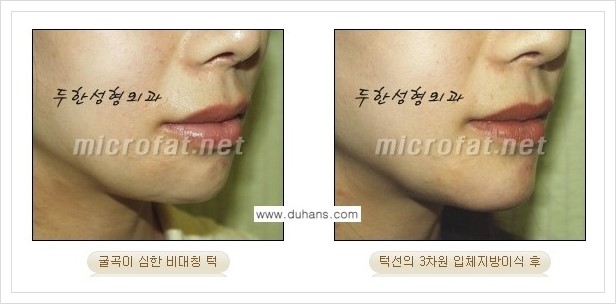 [두한성형외과 경쟁력 안면윤곽 교정] - [미세지방이식으로 무턱, 작은턱, 오목턱, 턱선의 비대칭 교정 안내] 관련 이미지 9