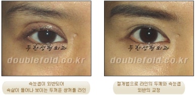 [Duhan Plastic Surgery Eye Surgery] - [Asymmetric Line, Eyelash Eversion, Deep Fixation] image 28