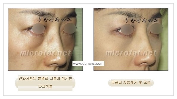 [두한성형외과 경쟁력 눈밑성형] - [눈밑지방제거, 눈위지방제거 안내 2.] 관련 이미지 8