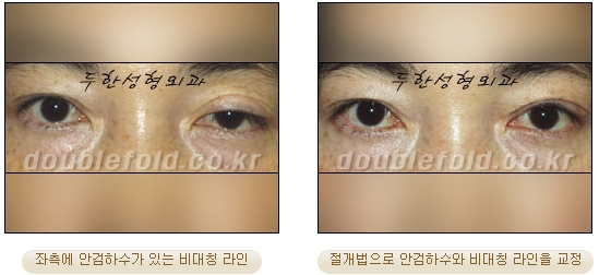[Duhan Plastic Surgery Secondary Double Eyelid Surgery] - [Sleepy Eye Appearance, Asymmetrical Eye Appearance, Ptosis] image 21