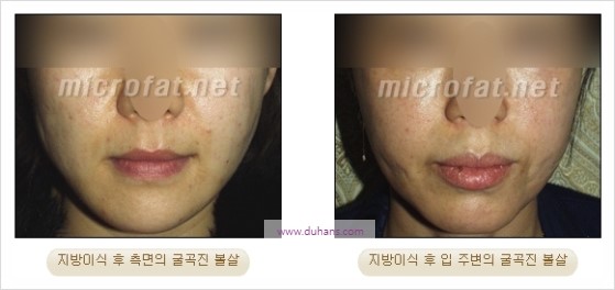 [두한성형외과 경쟁력 지방이식] - [두한 자가지방이식 클리닉 안내]​ 관련 이미지 62