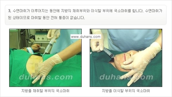 [두한성형외과 경쟁력 미세지방이식] - [부드럽고 아름다운 얼굴선 얼굴 미세지방이식 과정] 관련 이미지 3
