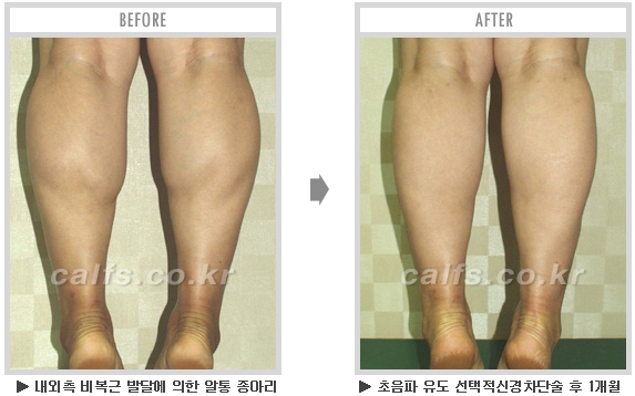 [종아리성형 두한성형외과] - [종아리수술에 대한 자주하는 질문과 답변 모음] 관련 이미지 58