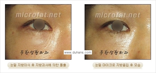 [두한성형외과 경쟁력 미세지방흡입] - [안면부의 안전한 미세지방흡입 안내] 관련 이미지 20