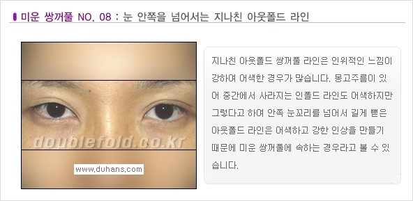 [두한성형외과 경쟁력 쌍꺼풀 재수술, 극한 재수술] - [일반적인 기준의 미운 쌍꺼풀과 아름다운 쌍꺼풀 안내] 관련 이미지 8