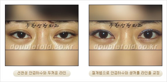 [두한성형외과 경쟁력 눈성형] - [안검하수(졸리운 눈매) 교정 방법 안내] 관련 이미지 24