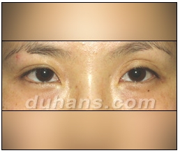 Candidates for Double Eyelid Revision Surgery: Unattractive Double Eyelids, Beautiful Double Eyelids image 11