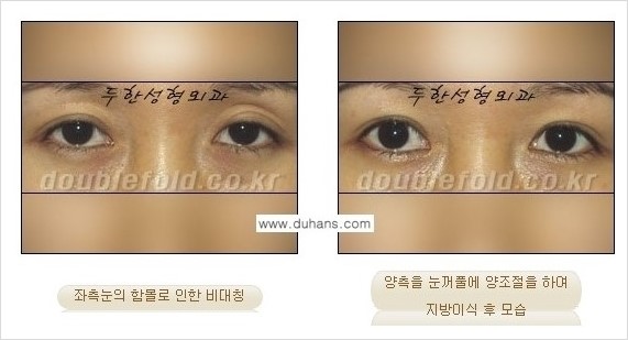 [두한성형외과 경쟁력 쌍꺼풀 재수술] - [쌍꺼풀 재수술 과정] 관련 이미지 100
