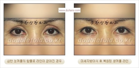 [두한성형외과 경쟁력 눈성형] - [쌍꺼풀 재수술 과정과 쌍꺼풀 재수술 실패의 원인, 쌍꺼풀 재수술의 성공 요건] 관련 이미지 52