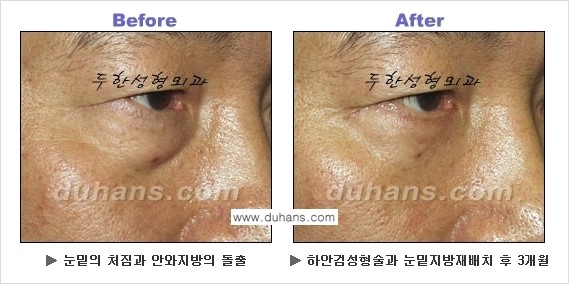 [두한성형외과의 상큼하고 환한 젊은 눈매완성] - [하안검 성형술 ②] 관련 이미지 16