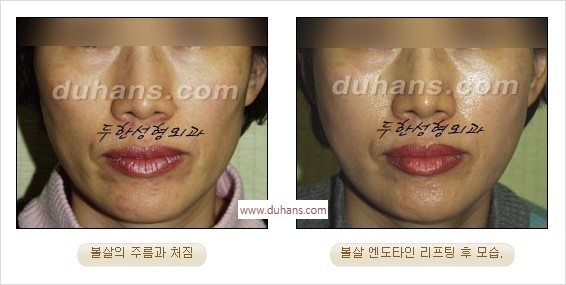 [두한성형외과 경쟁력 주름성형] - [간단하고 부작용 없는 자연스러운 주름제거 방법] 관련 이미지 28