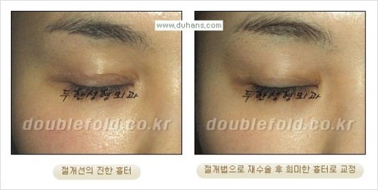 [두한성형외과 경쟁력 눈성형] - [쌍꺼풀 재수술 대상과 재수술의 문제점, 미운쌍꺼풀, 재수술 방법들] 관련 이미지 83