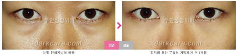 [두한성형외과 다크서클] - [다크서클 전후사진 검증] 관련 이미지 92