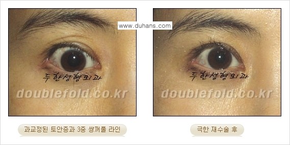 [두한성형외과 경쟁력 쌍꺼풀 재수술, 극한 눈재수술] - [망친 쌍꺼풀을 복원하는 극한 눈재수술] 관련 이미지 14
