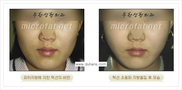 [두한성형외과 겨울엔 지방흡입을] - [볼살, 눈밑, 턱선의 초음파 미세지방흡입 1.] 관련 이미지 14
