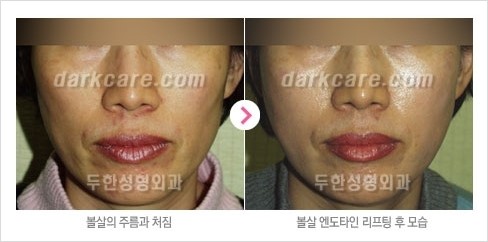 [두한성형외과 경쟁력 주름성형] - [주름제거를 위한 리프팅] 관련 이미지 25