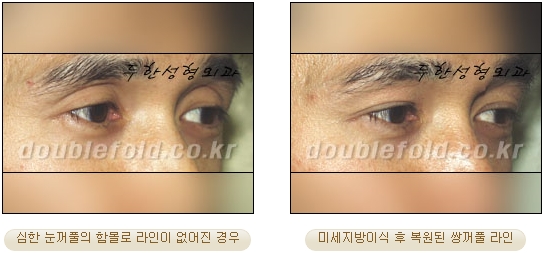 [Duhan Plastic Surgery Double Eyelid Revision Surgery] - [Correcting the Double Eyelid Line in Sunken Eyelids] image 37