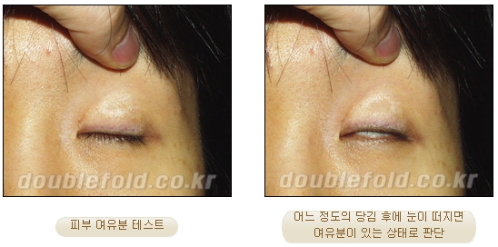 [Duhan Plastic Surgery Reoperation for Double Eyelids] - [Lowering the Double Eyelid Line] image 14