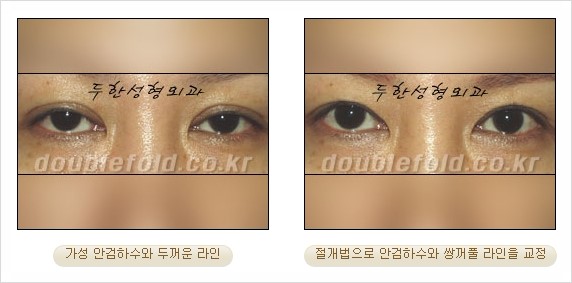 [두한성형외과 경쟁력 눈성형] - [안검하수(졸리운 눈매) 교정 방법 안내] 관련 이미지 18
