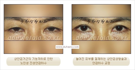 [두한성형외과 경쟁력 눈성형] - [안검하수(졸린눈매) 눈매교정 여러 가지 방법 안내] 관련 이미지 7