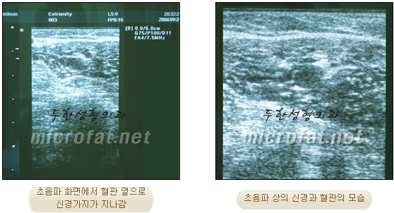 [Duhan Plastic Surgery Clinic Calf Contouring] - [Calf Reduction] image 12