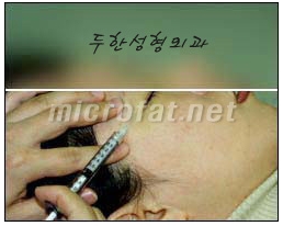 [Duhan Plastic Surgery Wrinkle Improvement] - [Wrinkle Filler Procedure] image 8