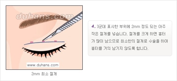 [두한성형외과 경쟁력 눈성형]- [최소 부기로 일상의로의 복귀가 가능한 아름다운 퀵쌍꺼풀(부분절개법) 수술] 관련 이미지 4