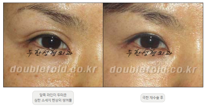 [Double Eyelid Surgery, Duhan Plastic Surgery] - [Extreme Revision Eye Surgery to Correct a Damaged Line] image 6