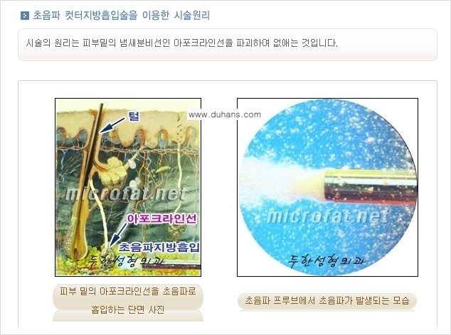 [두한성형외과 경쟁력 액취증, 다한증 치료] - [겨드랑이의 참기 힘든 냄새와 땀 치료 - 초음파 컷터지방흡입 + 리포셋 소파흡입술] 관련 이미지 3