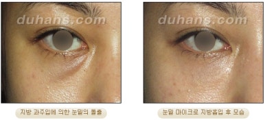 [두한성형외과 안전한 지방흡입] - [얼굴지방흡입] 관련 이미지 19