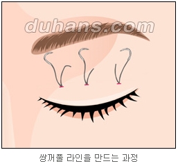 쌍커풀수술 두한성형외과 - 나에게 맞는 눈성형은? 관련 이미지 25