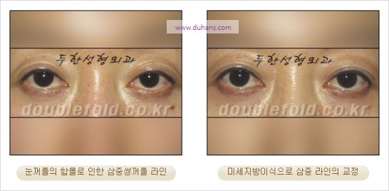 [두한성형외과 경쟁력 눈성형] - [쌍꺼풀 재수술 과정과 쌍꺼풀 재수술 실패의 원인, 쌍꺼풀 재수술의 성공 요건] 관련 이미지 55