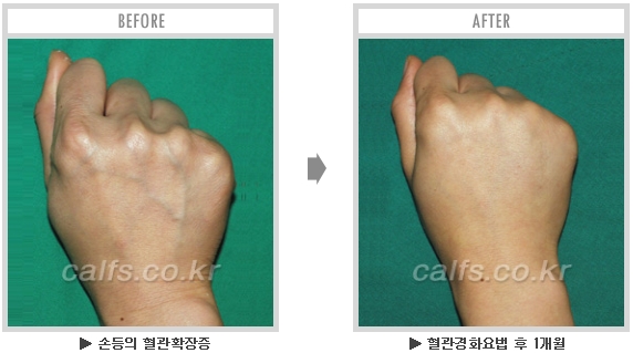 [종아리성형 두한성형외과] - [종아리수술에 대한 자주하는 질문과 답변 모음] 관련 이미지 33