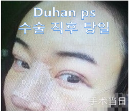 [Duhan Plastic Surgery] [Revision Double Eyelid Surgery, Uneven Eyes, Asymmetric Eyes, Uneven Double Eyelids, Increasing the Double Eyelid Line, Under-Eye Surgery, Dark Circles, Nose Revision Surgery] image 3