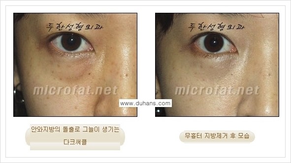 [두한성형외과 경쟁력 눈밑성형] - [눈밑지방제거, 눈위지방제거 안내 1.] 관련 이미지 20