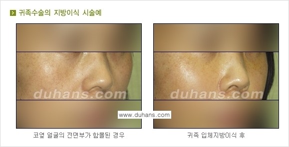 ​​​⁠[두한성형외과 경쟁력 미세지방이식] - [귀족수술 - 입체미세지방이식 ②] 관련 이미지 7