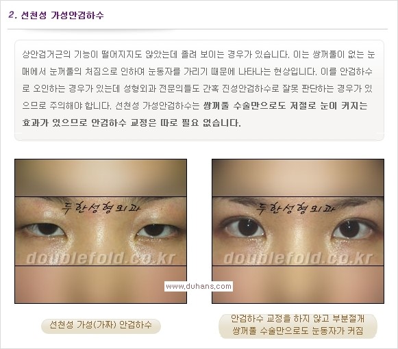 [두한성형외과 경쟁력 쌍꺼풀 재수술, 극한 눈재수술] - [안검하수 종류 안내] 관련 이미지 4