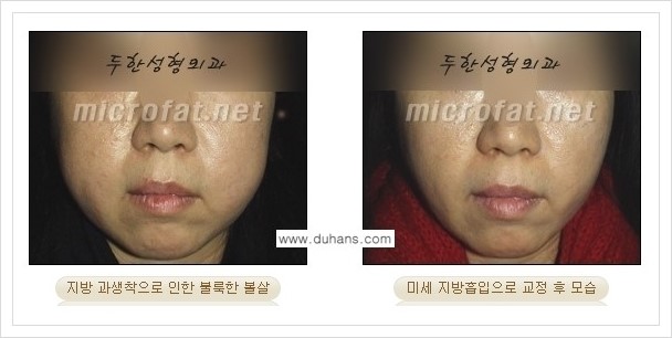 [두한성형외과 경쟁력 볼살지방이식] - [타병원 지방이식 후 - 굴곡이 발생한 경우, 과주입으로 인해 볼살이 불룩한 경우 안내] 관련 이미지 13
