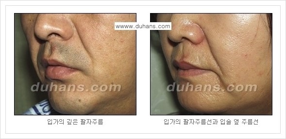 ​[두한성형외과 경쟁력 주름성형] - [주름교정을 위한 미세지방이식 안내 1.] 관련 이미지 6