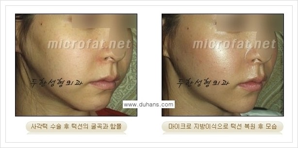 [두한성형외과 경쟁력 볼살지방이식] - [타병원 지방이식 후 - 굴곡이 발생한 경우, 과주입으로 인해 볼살이 불룩한 경우 안내] 관련 이미지 7
